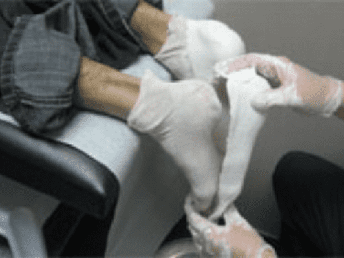 Shape capture or casting of a foot to make a foot orthosis / orthotic